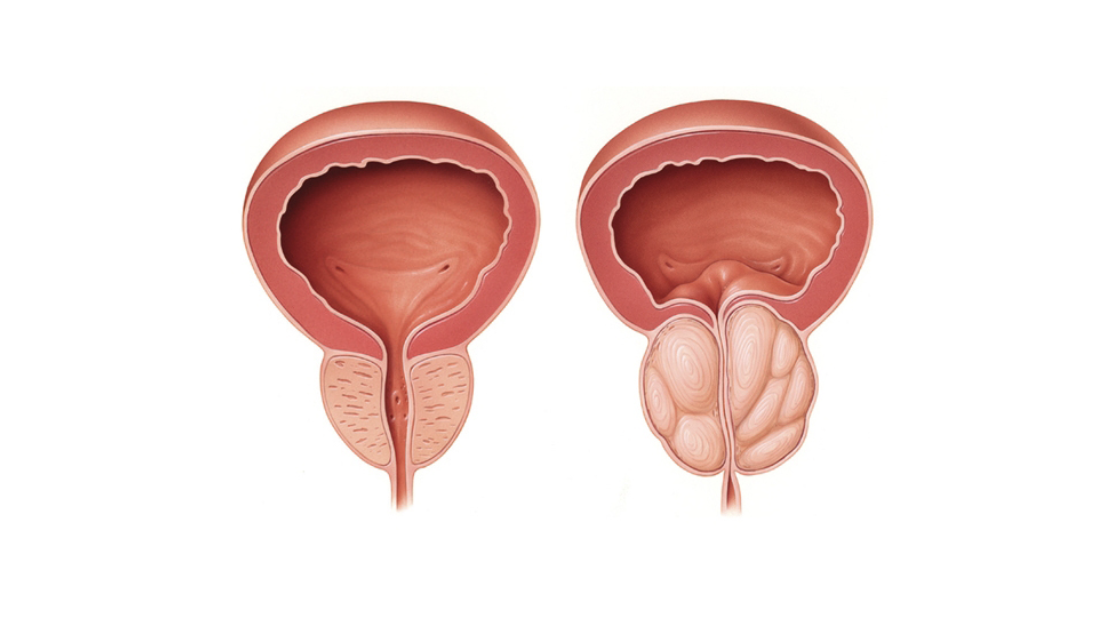 Prostate Enlargement